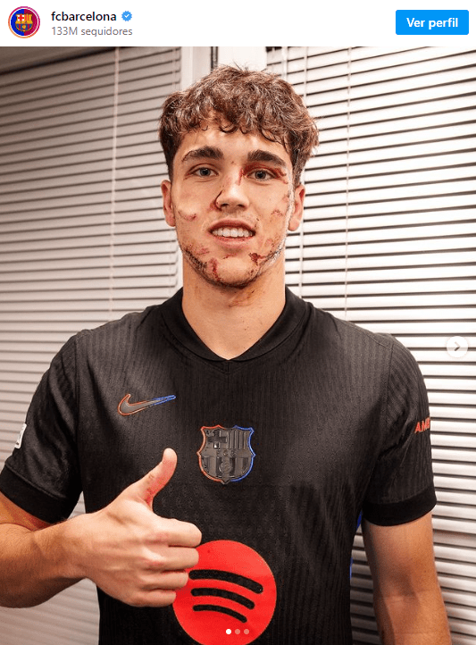 Pau Cubarsí sufre una fuerte lesión en el rostro durante FC Barcelona contra el Estrella Roja